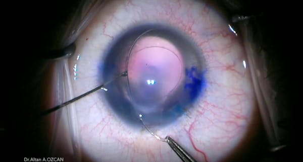 Aniridia With Astigmatism thumbnail