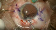 Traumatic Iris/Lens Loss