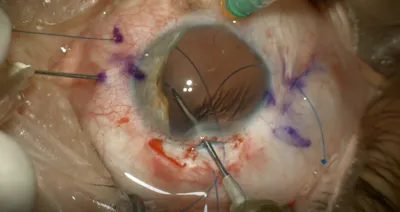 Traumatic Iris/Lens Loss thumbnail