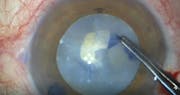 Subcapsular Fibrosis