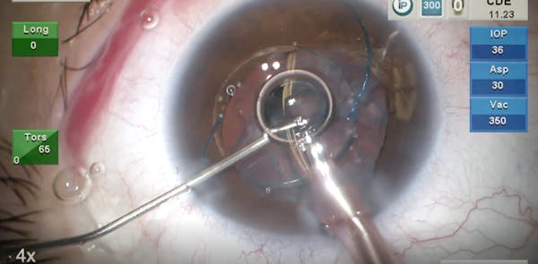 Ectopia Lentis thumbnail