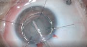 Microspherophakia