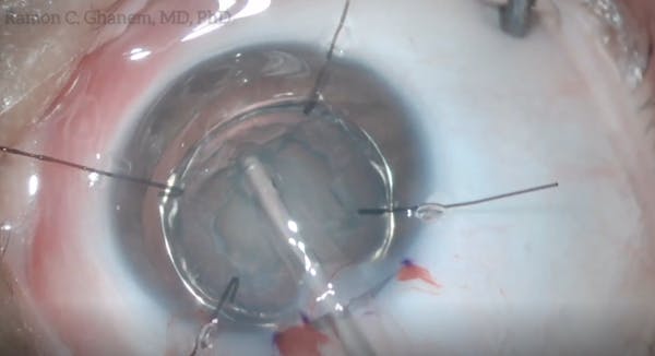 Microspherophakia thumbnail
