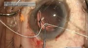 Traumatic Zonulopathy