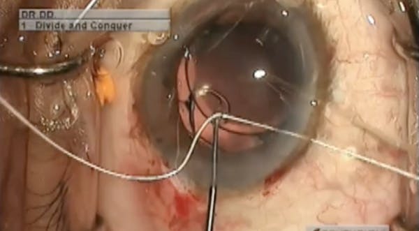 Traumatic Zonulopathy thumbnail