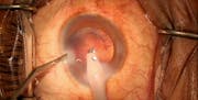 Posterior Capsule Puncture