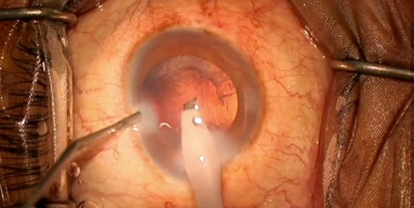 Posterior Capsule Puncture thumbnail