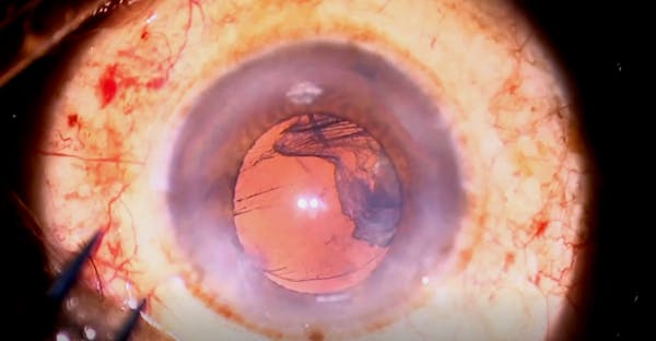 Zonular Dialysis thumbnail