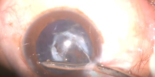 Aphakia After Congenital Cataract