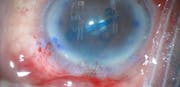 Pseudophakic Bullous Keratopathy