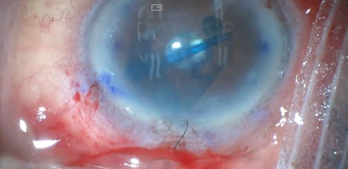 Pseudophakic Bullous Keratopathy