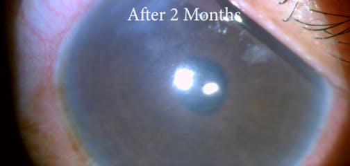 Polypharmacy Psychosis