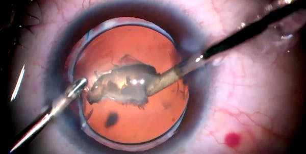Capsular Phimosis thumbnail