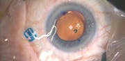 Decentered/Rotated Toric IOL