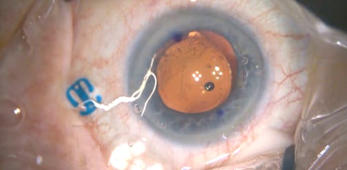 Decentered/Rotated Toric IOL