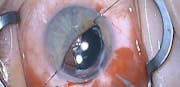 Dislocated Iris Prosthesis
