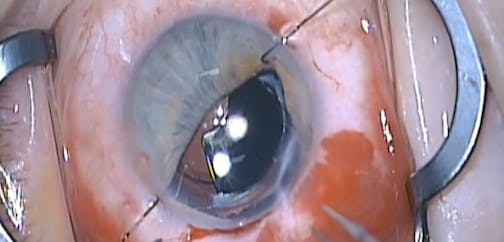 Dislocated Iris Prosthesis