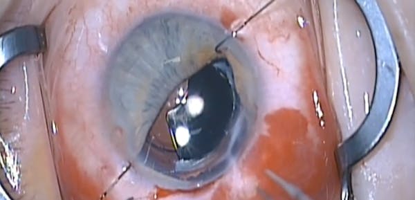 Dislocated Iris Prosthesis thumbnail