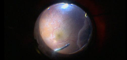 Pseudophakic Retinal Detachment