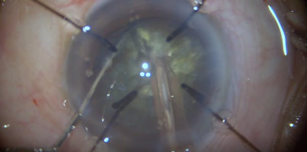 Phacoemulsification in Extreme Zonular Weakness thumbnail