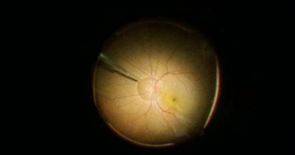 Retinal Detachment Repair During Cataract Surgery thumbnail