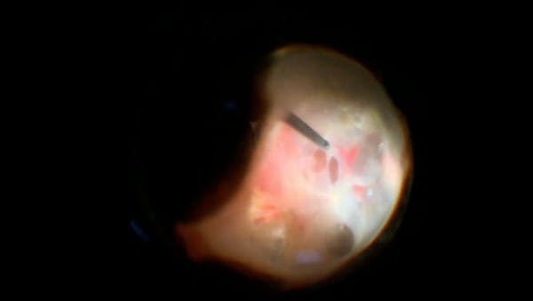 Silicone Ablation thumbnail