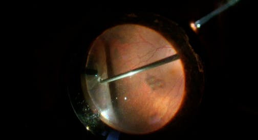Vitrectomy for Thick Macular Retinal Fold