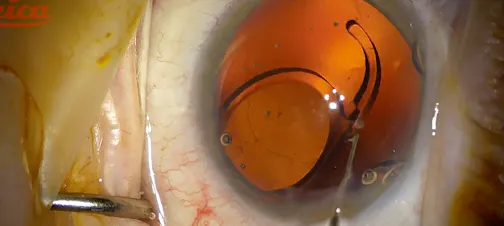 Lens Exchange With Youssef Explantation Forceps