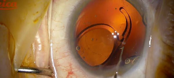 Lens Exchange With Youssef Explantation Forceps thumbnail