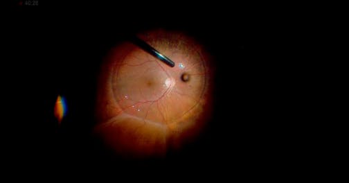 Post-Pneumatic Retinopexy Retinal Detachment With PVR