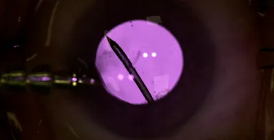 Visualizing the Vitreous With IR thumbnail