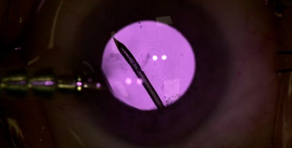 Visualizing the Vitreous With IR thumbnail