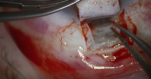 Combined Cataract, Deep Sclerectomy, and Canaloplasty for Chronic Open-Angle Glaucoma