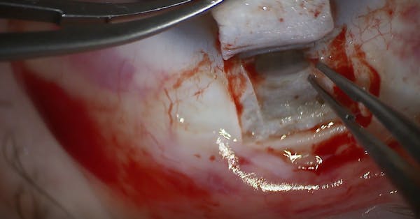 Combined Cataract, Deep Sclerectomy, and Canaloplasty for Chronic Open-Angle Glaucoma thumbnail