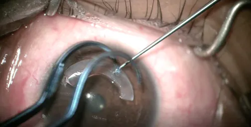 Single Incision, No Dehydration CAIRS Technique