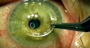 Corneal Ectasia, Fuchs Dystrophy, and Cataract After Hexagonal Keratotomy