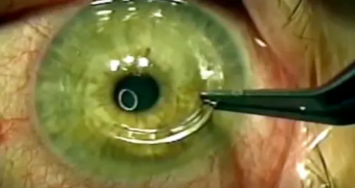 Corneal Ectasia, Fuchs Dystrophy, and Cataract After Hexagonal Keratotomy