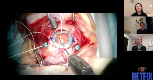 Episode 13 Part 1: Secondary IOL Pearls