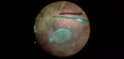 Vitreous Staining With Triamcinolone Acetonide