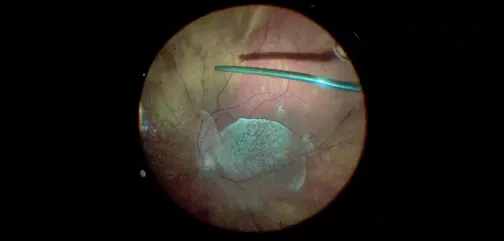Vitreous Staining With Triamcinolone Acetonide