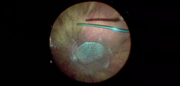 Vitreous Staining With Triamcinolone Acetonide thumbnail