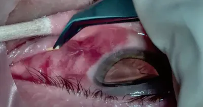Dextenza Insertion After Retina Surgery thumbnail