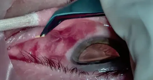 Dextenza Insertion After Retina Surgery