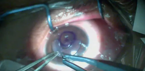 Cornea Tissue Addition Keratoplasty