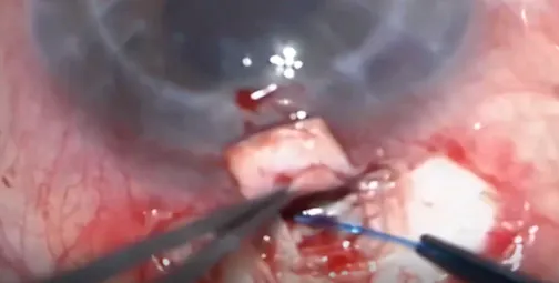 Ab Externo Circumferential Suture Trabeculotomy in Treatment of Post-Keratoplasty Glaucoma