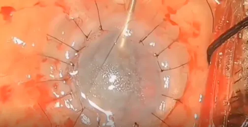 Value Additions to High-Risk Keratoplasty