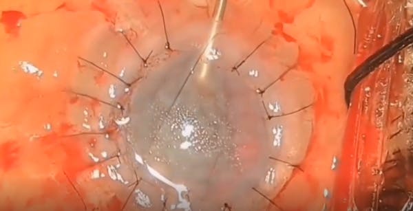 Value Additions to High-Risk Keratoplasty thumbnail