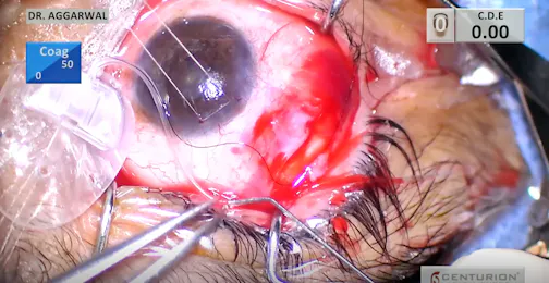 Pre-Placing Sutures for Ahmed Glaucoma Valve