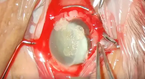Tips and Tricks for Therapeutic Penetrating Keratoplasty