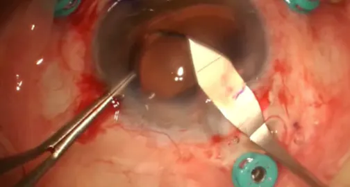 Exchange of Tilted Yamane-Fixated IOL With 4-Point Scleral-Sutured IOL